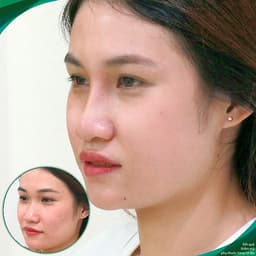 Thẩm Mỹ Ruby Beauty - Bác Sĩ Lương Ngọc|Mũi Đẹp Tự Nhiên - Cải Thiện Vận Số