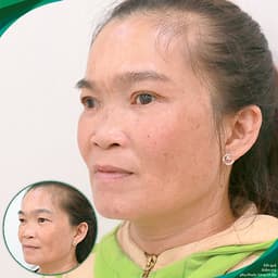 Thẩm mỹ Ruby Beauty - Bác sĩ Lương Ngọc|Thẩm mỹ mắt đẹp