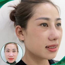 Thẩm Mỹ Ruby Beauty - Bác Sĩ Lương Ngọc|Mũi Đẹp Tự Nhiên - Cải Thiện Vận Số