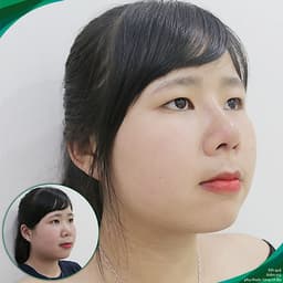 Thẩm Mỹ Ruby Beauty - Bác Sĩ Lương Ngọc|Mũi Đẹp Tự Nhiên - Cải Thiện Vận Số