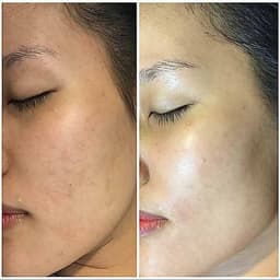 1 Trong Các DỊch Vụ Chăm Sóc Da Mặt Thư Giãn Tuyệt Đối Tại Ấm Brows & Spa