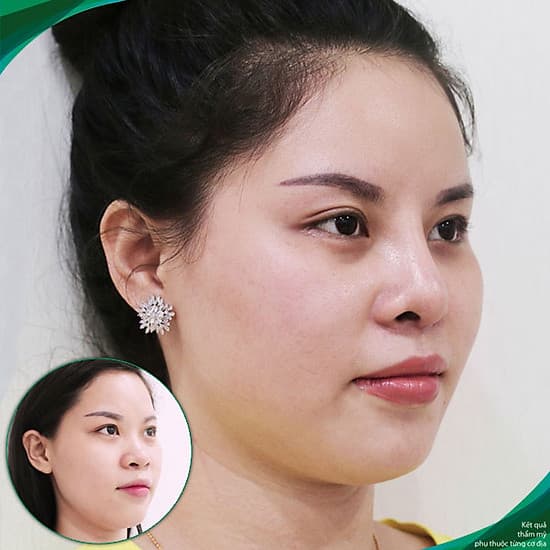 Thẩm Mỹ Ruby Beauty - Bác Sĩ Lương Ngọc|Mũi Đẹp Tự Nhiên - Cải Thiện Vận Số
