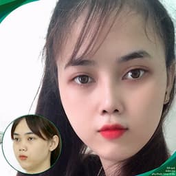 Thẩm Mỹ Ruby Beauty - Bác Sĩ Lương Ngọc|Mũi Đẹp Tự Nhiên - Cải Thiện Vận Số