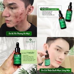 Serum ngừa mụn nám sẹo thâm rỗ tàn nhang XBeauty Hyma Acnes (30ml/10ml). Dòng kem ngăn ngừa mụn thâm sẹo rỗ