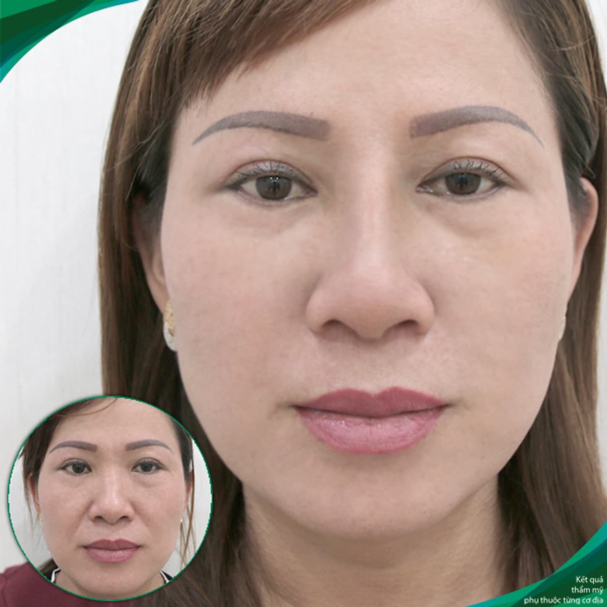 Thẩm Mỹ Ruby Beauty - Bác Sĩ Lương Ngọc|Mũi Đẹp Tự Nhiên - Cải Thiện Vận Số