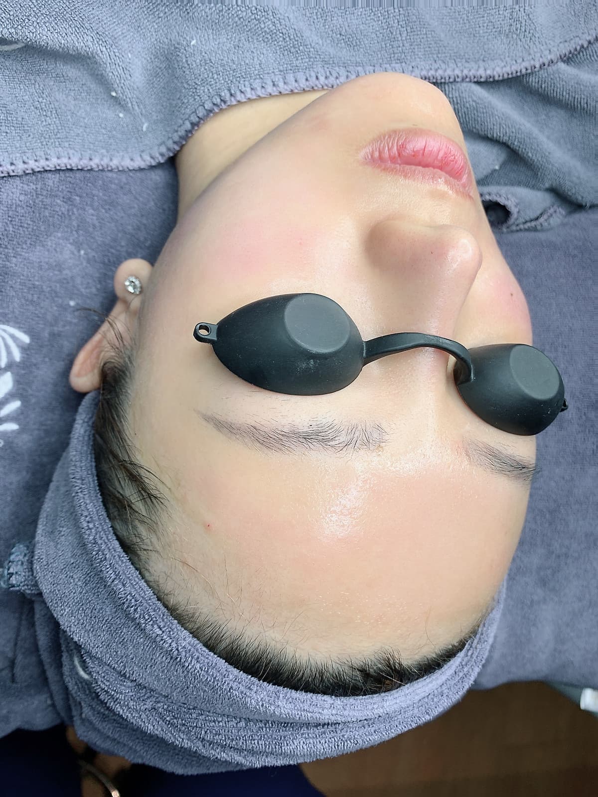 Gói phi kim mụn_Q Beauty Spa