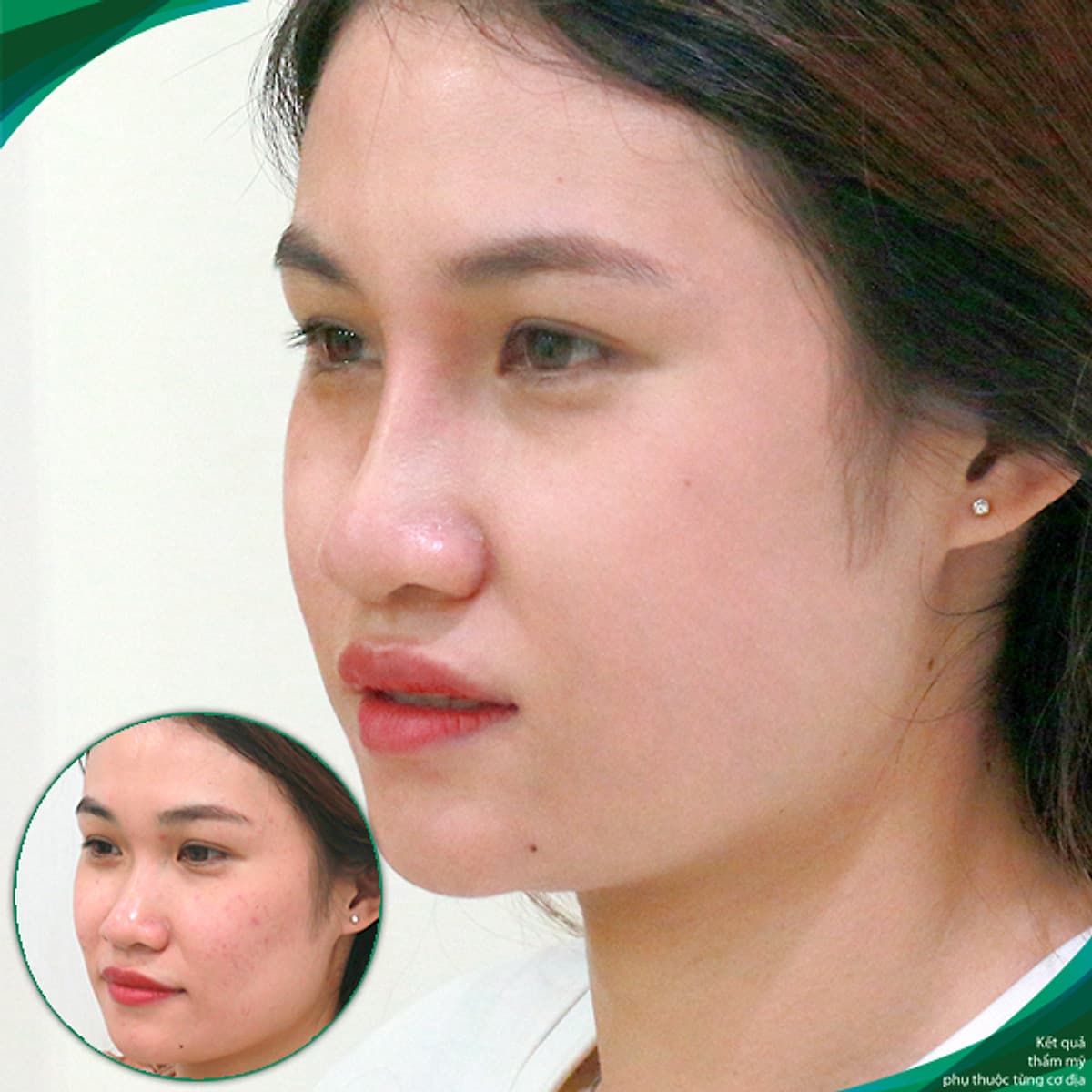 Thẩm Mỹ Ruby Beauty - Bác Sĩ Lương Ngọc|Mũi Đẹp Tự Nhiên - Cải Thiện Vận Số