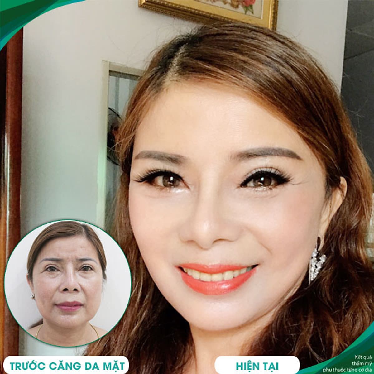 Thẩm Mỹ Ruby Beauty - Bác Sĩ Lương Ngọc|Lưu Giữ Thanh Xuân Với Dịch Vụ Căng Da Trẻ Hóa Và Tạo Má Lúm Đồng Tiền
