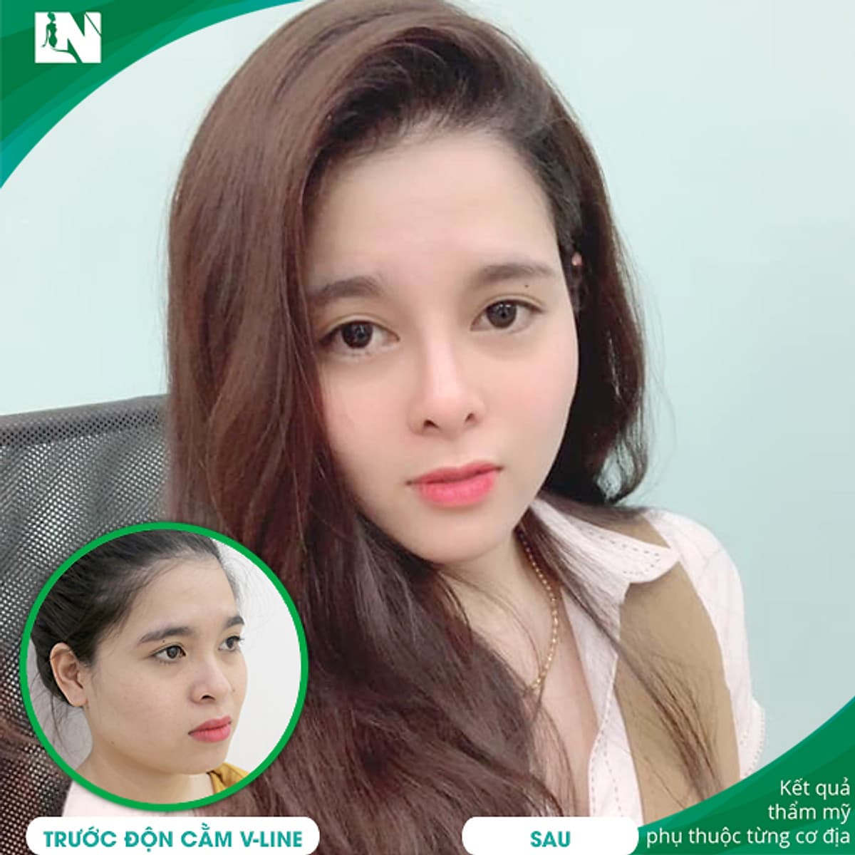 Thẩm Mỹ Ruby Beauty - Bác Sĩ Lương Ngọc|Gương Mặt Thanh Thoát Nhờ Cằm V-Line