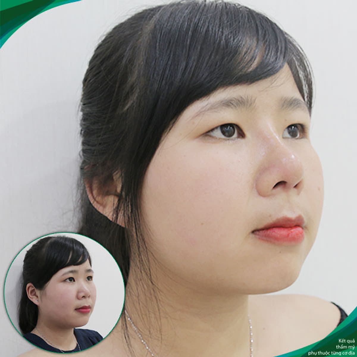 Thẩm Mỹ Ruby Beauty - Bác Sĩ Lương Ngọc|Mũi Đẹp Tự Nhiên - Cải Thiện Vận Số