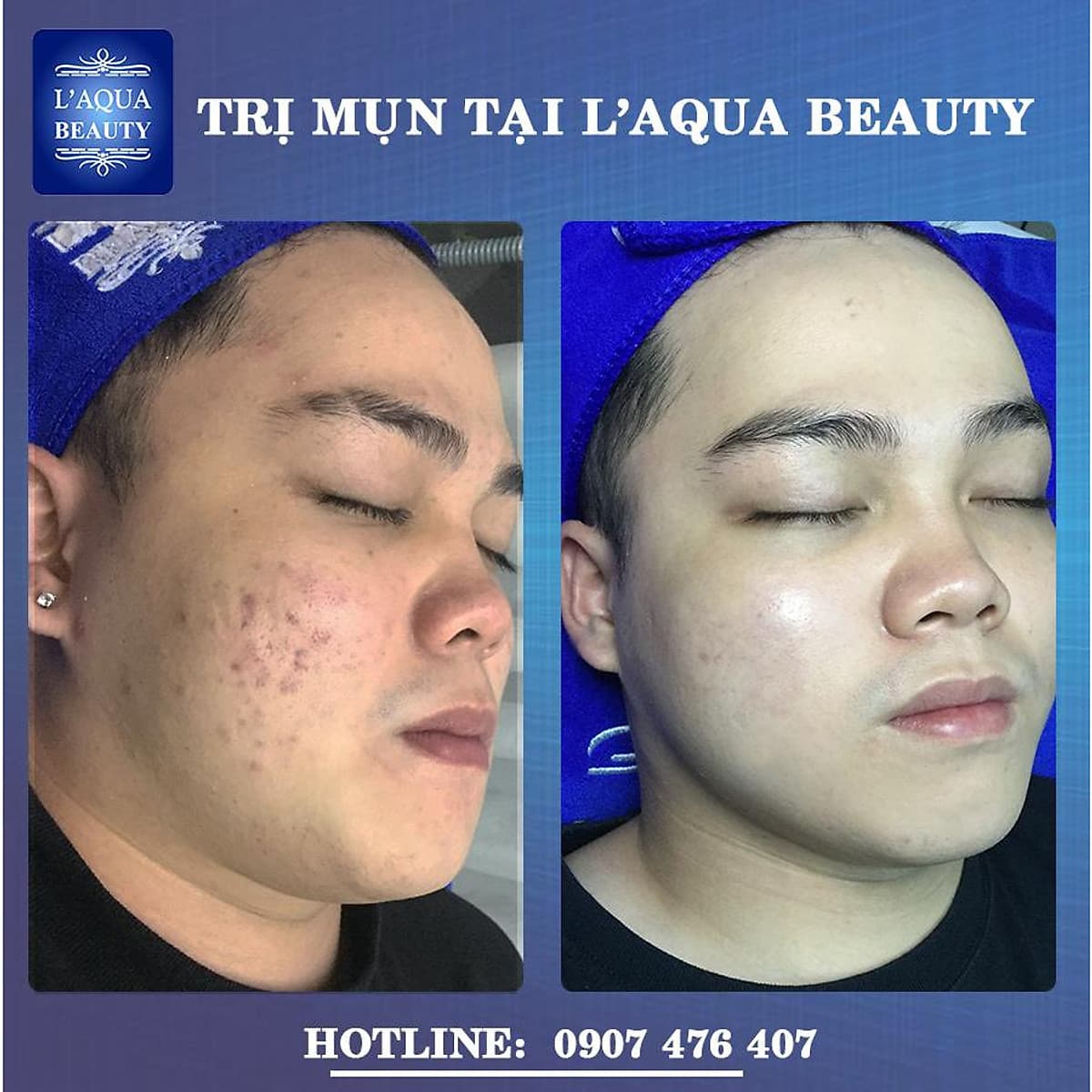 DETOX DA - CHĂM SÓC DA MỤN VỚI 8N1 TẠI L’AQUA BEAUTY
