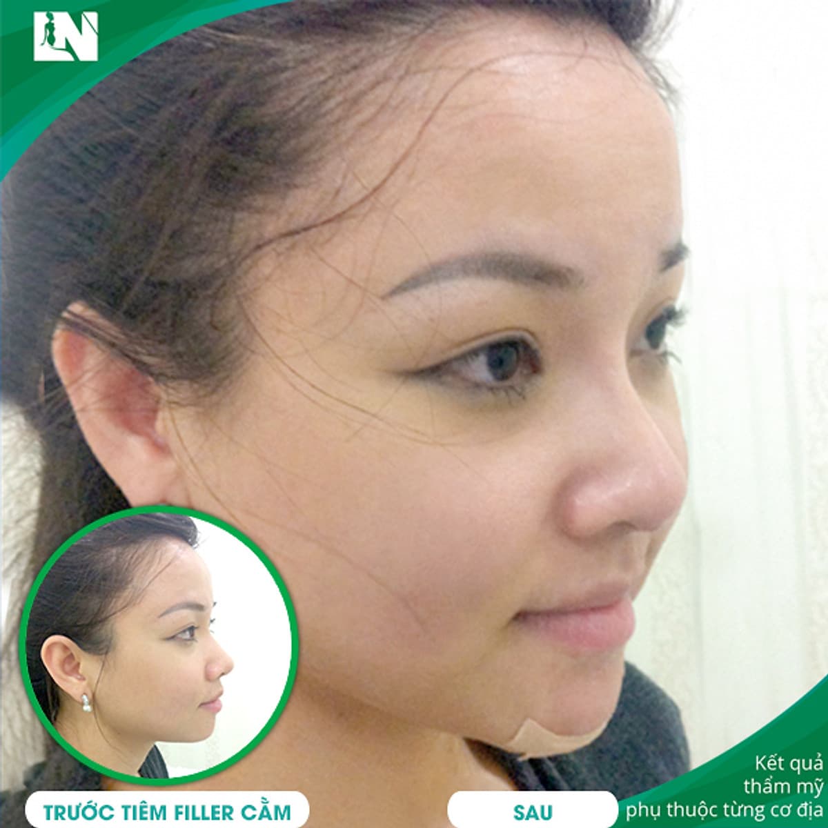 Thẩm Mỹ Ruby Beauty - Bác Sĩ Lương Ngọc|Gương Mặt Thanh Thoát Nhờ Cằm V-Line