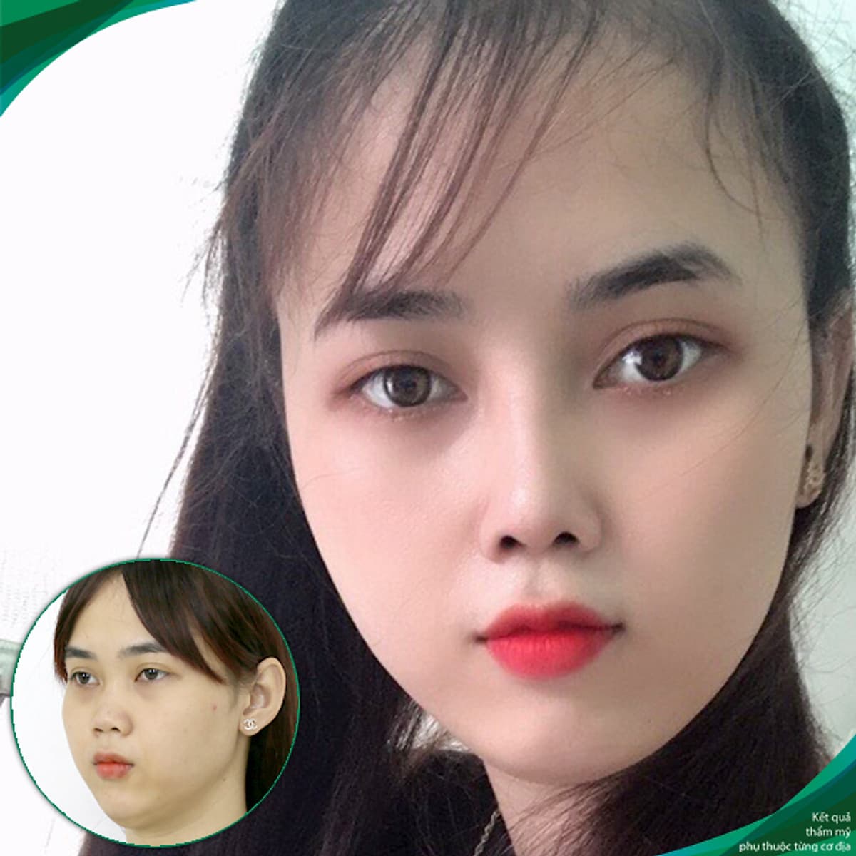 Thẩm Mỹ Ruby Beauty - Bác Sĩ Lương Ngọc|Mũi Đẹp Tự Nhiên - Cải Thiện Vận Số
