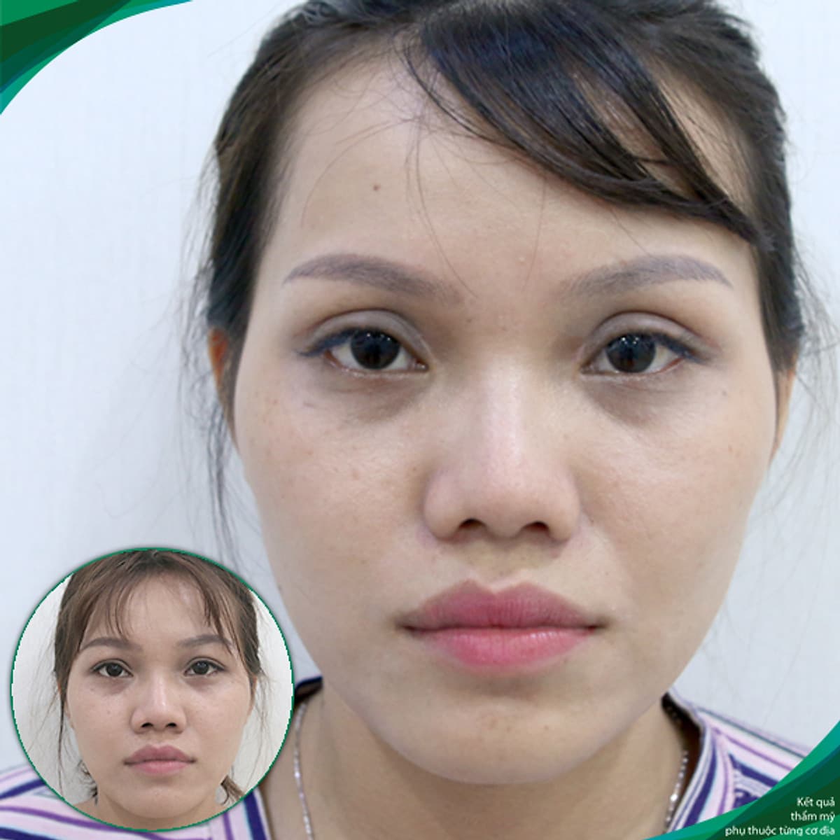 Thẩm Mỹ Ruby Beauty - Bác Sĩ Lương Ngọc|Mũi Đẹp Tự Nhiên - Cải Thiện Vận Số