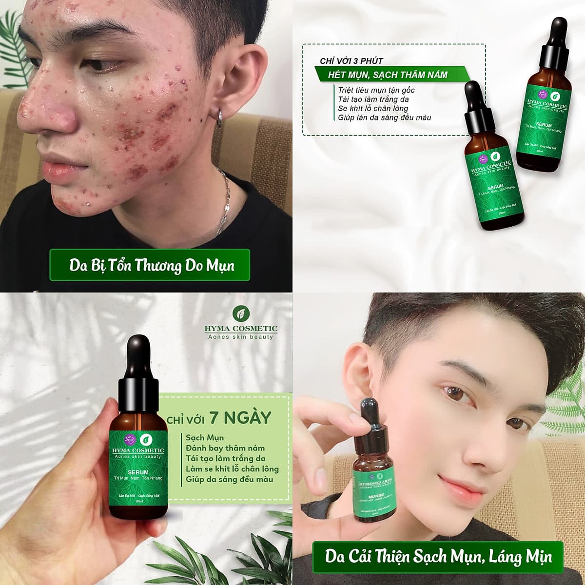 Serum ngừa mụn nám sẹo thâm rỗ tàn nhang XBeauty Hyma Acnes (30ml/10ml). Dòng kem ngăn ngừa mụn thâm sẹo rỗ