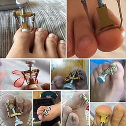 Dụng Cụ Bẻ Móng Quặp Thịt